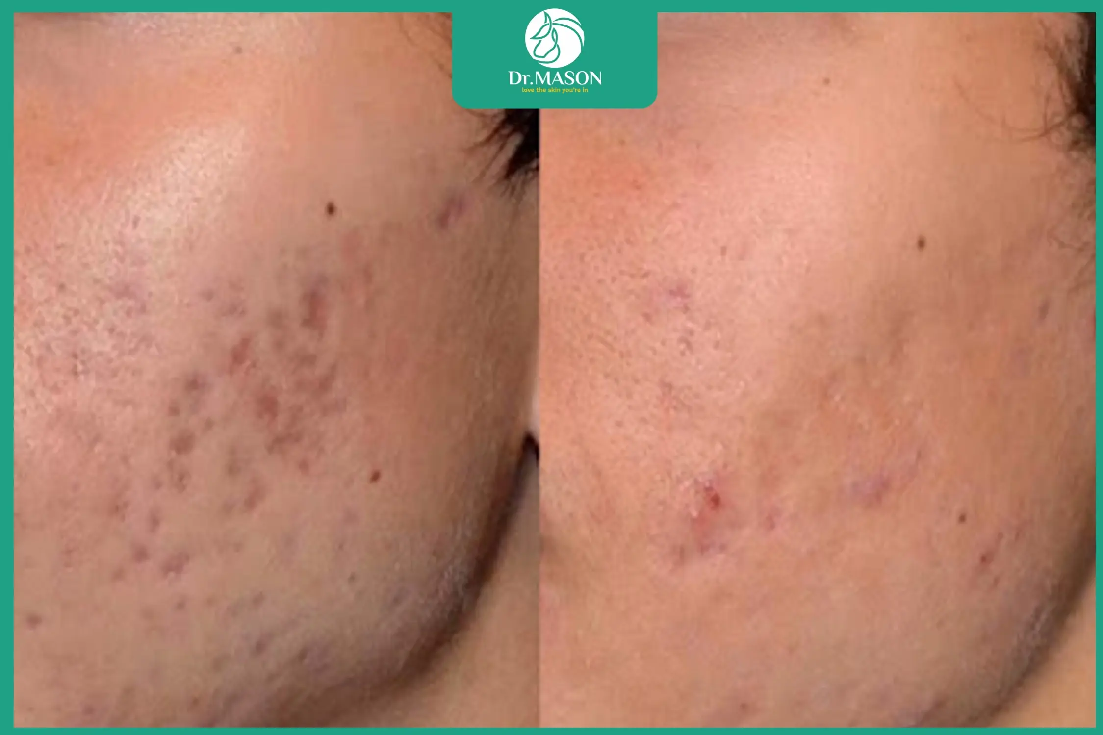 trước và sau khi điều trị sẹo rỗ fractional CO2