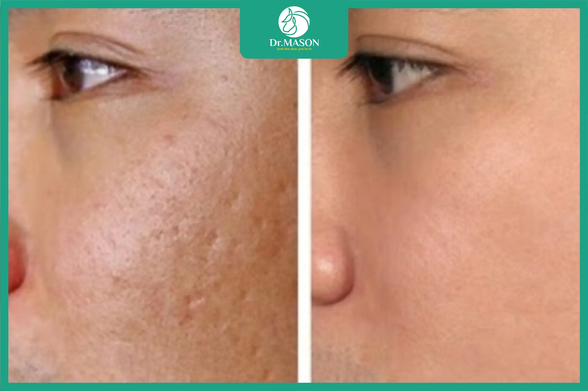 Hình ảnh so sánh trước và sau khi trị sẹo rỗ bằng laser CO2, bề mặt da phẳng và mịn hơn