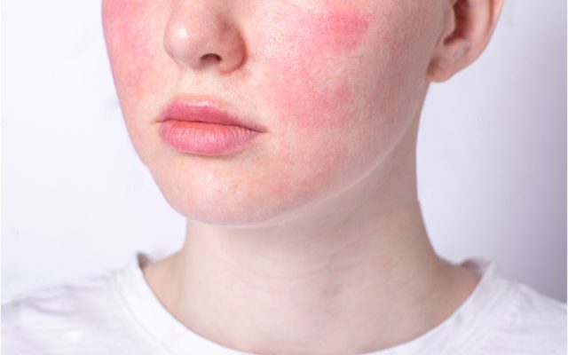 Da yếu sau treatment Da yếu sau treatment