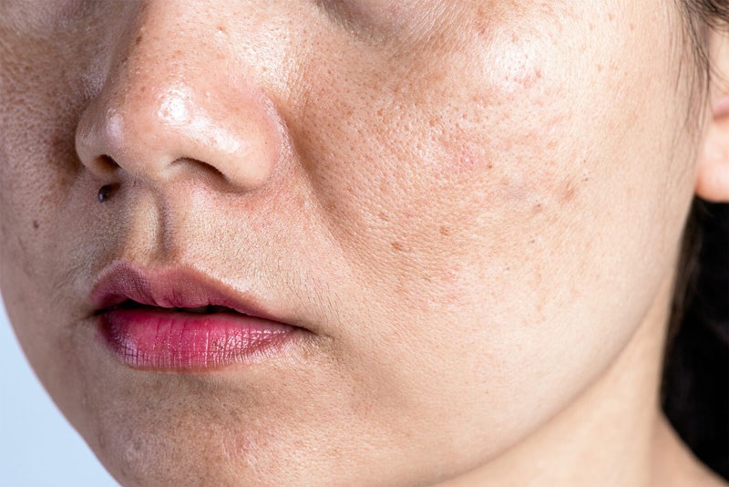 Nám da (Melasma) là một tình trạng rối loạn sắc tố da, xuất hiện khi các tế bào Melanocytes (tế bào hắc tố) hoạt động quá mức, sản sinh ra quá nhiều sắc tố Melanin. Nám da (Melasma) là một tình trạng rối loạn sắc tố da, xuất hiện khi các tế bào Melanocytes (tế bào hắc tố) hoạt động quá mức, sản sinh ra quá nhiều sắc tố Melanin.