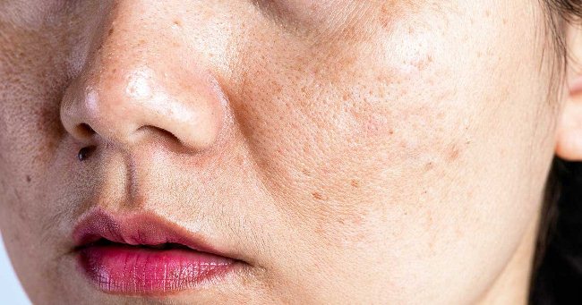 Nám và tàn nhang là nỗi lo lắng chung của nhiều phụ nữ, ảnh hưởng đến sự tự tin với làn da. Nám và tàn nhang là nỗi lo lắng chung của nhiều phụ nữ, ảnh hưởng đến sự tự tin với làn da.