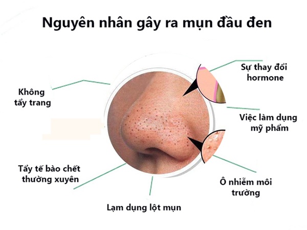 Các tác nhân dẫn đến mụn đầu đen Các tác nhân dẫn đến mụn đầu đen