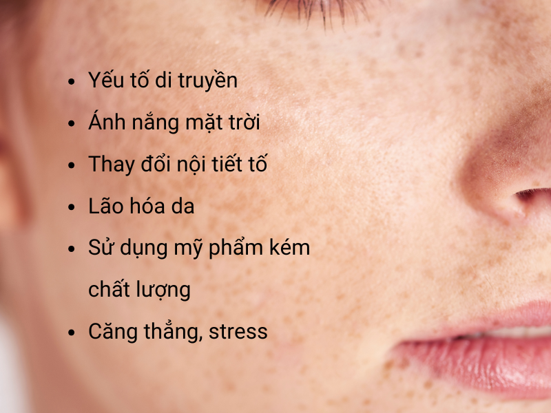 Nguyên nhân gây nám và tàn nhang Nguyên nhân gây nám và tàn nhang