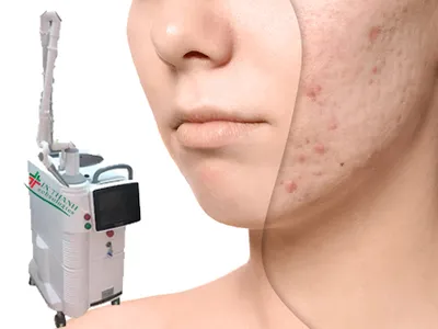 Trị sẹo rỗ, sẹo lồi bằng công nghệ Laser CO2 Fractional