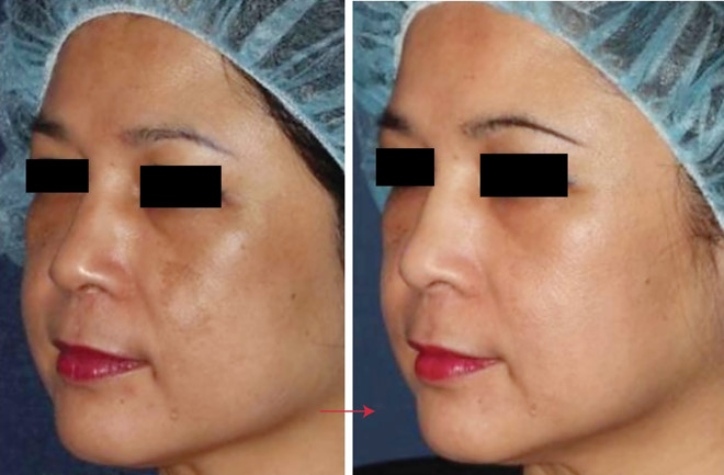 may laser picosure Dieu_tri_nam_bang_LS_Picosure_4.jpg (63 KB)