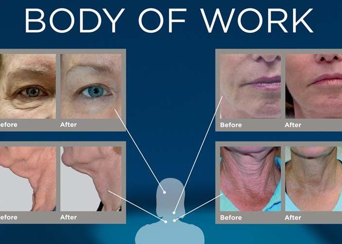 Máy xóa nhăn và giảm béo Exilis ket qua Exilis.jpg (49 KB)