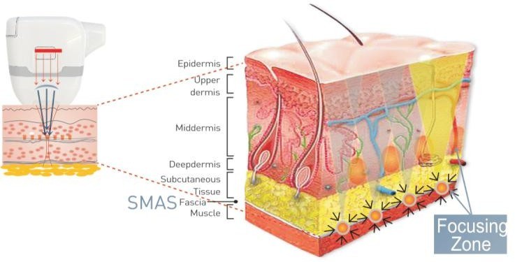 máy trẻ hóa da hifu sus1.jpg (51 KB)