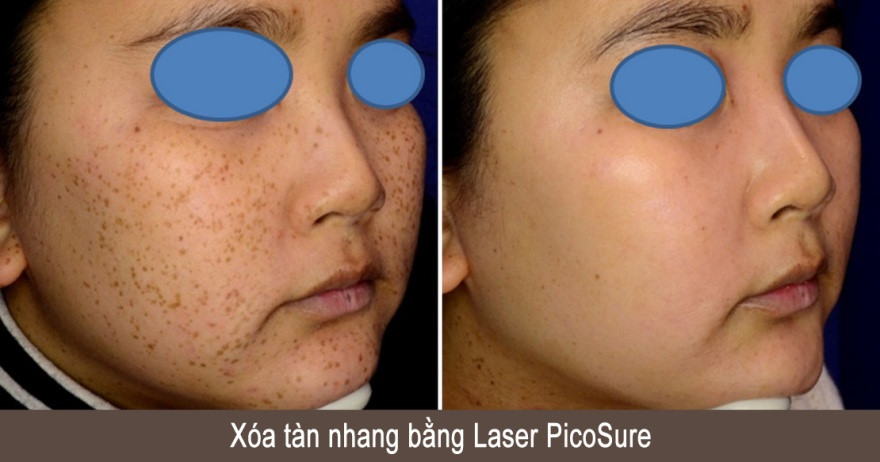 may laser picosure xoa tan nhang bang picosure.jpg (88 KB)