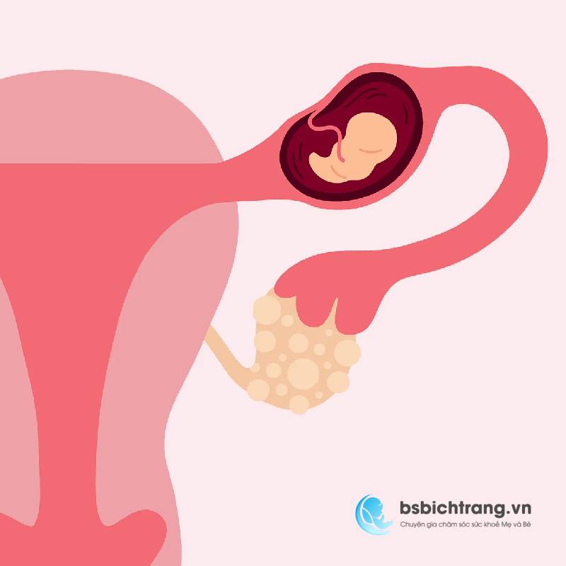 Những bệnh lý thường gặp khi mang thai - Chia sẻ từ Bs Bích Trang BMT – Chuyên gia chăm sóc sức khỏe Mẹ và Bé