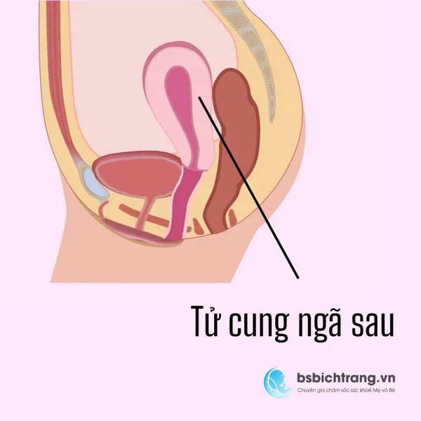 Tử cung ngã sau có ảnh hưởng tới khả năng mang thai hay không?