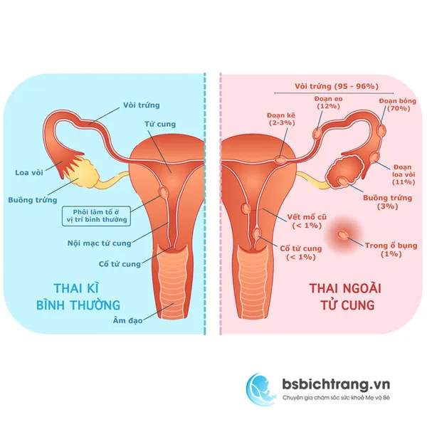Thai ngoài dạ con là gì? Chia sẻ từ Bs Bích Trang BMT – Chuyên gia chăm sóc sức khỏe Mẹ và Bé