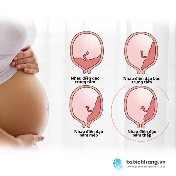 Nhau tiền đạo có nguy hiểm không?