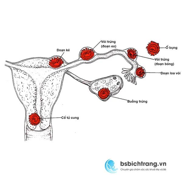 Thai ngoài tử cung có thể điều trị không?