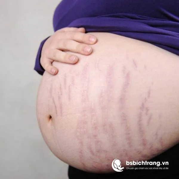 Làm sao để hạn chế rạn da cho Mẹ bầu? Chia sẻ từ Bs Bích Trang BMT - Chuyên gia chăm sóc sức khoẻ Mẹ và Bé