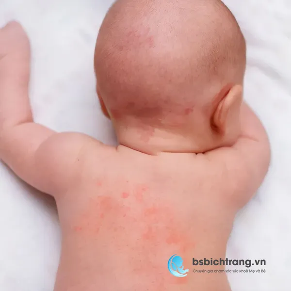 Bé bị nổi rôm sẩy phải làm sao?
