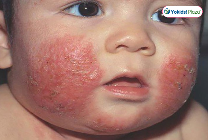 Dấu hiệu nhận biết da bé đang bị khô nứt