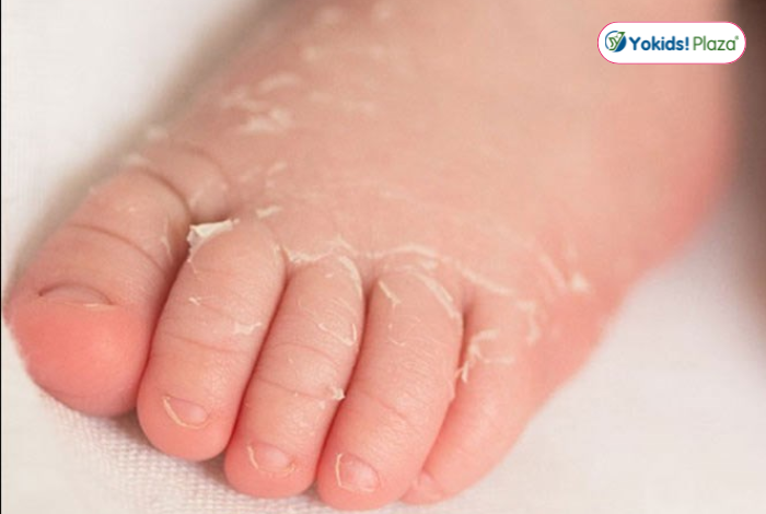 Đặc điểm làn da của bé khiến da dễ khô nứt