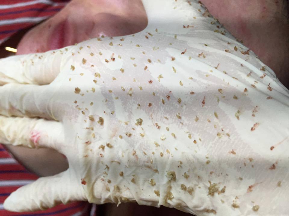 Địa Chỉ Nặn Mụn và Lấy Nhân Mụn Ở Gò Vấp Uy Tín An Toàn Không Để Lại Thâm