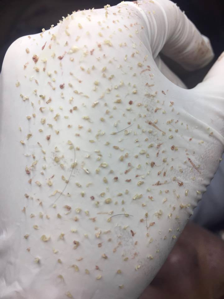 Nặn Mụn và Lấy Nhân Mụn Ở Gò Vấp