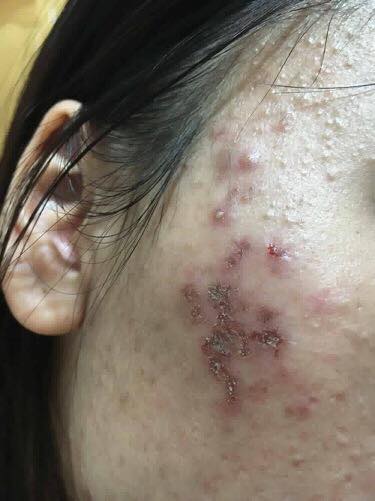 Nặn mụn và lấy nhân mụn
