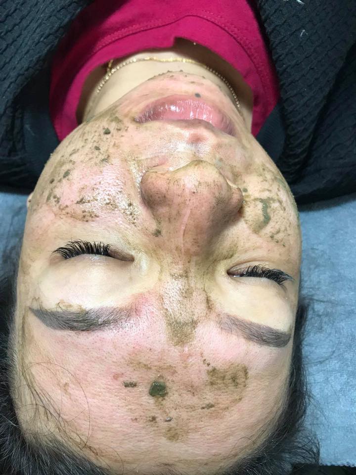 Peel Da Vi Tảo tại nhà Gami Spa