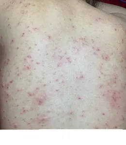 CHEMICAL PEEL TRỊ MỤN LƯNG