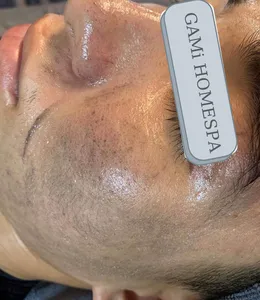 Hút Chì Thải Độc Da
