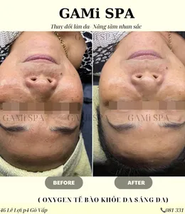 KẾT QUẢ OXYGEN TẾ BÀO GIẢM MỤN NÁM PHỤC HỒI DA