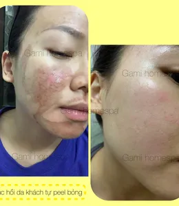 KẾT QUẢ PHỤC HỒI DA MỎNG YẾU, BỎNG PEEL, KÍCH ƯNG