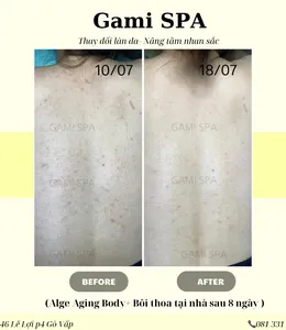 KẾT QUẢ TRỊ MỤN THÂM LƯNG BODY