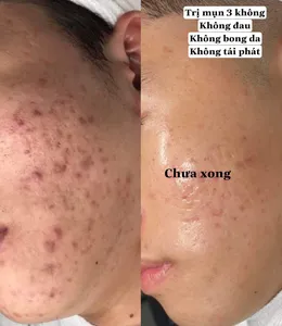KẾT QUẢ TRỊ MỤN THÂM