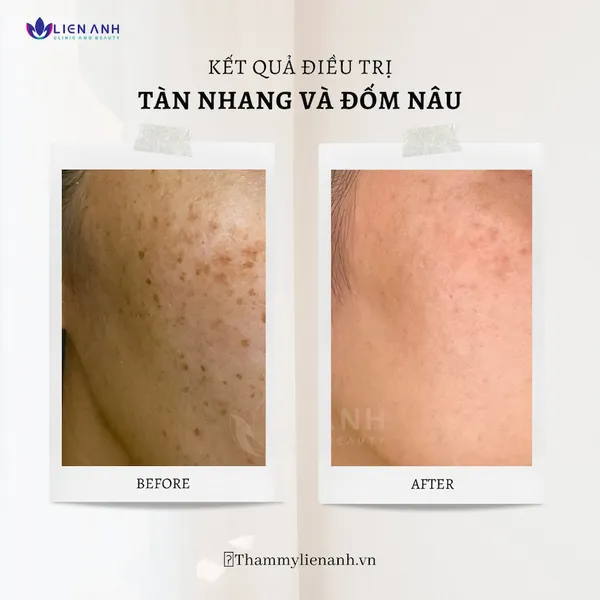 Trị đốm nâu 2 má - Laser Toning