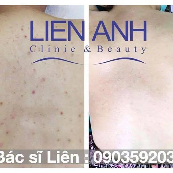 Trị mụn lưng - Phi kim