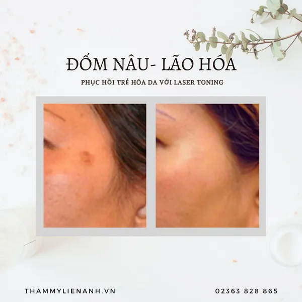 Trị đốm nâu - Laser Toning