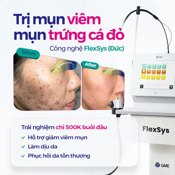 Trị mụn đa công nghệ