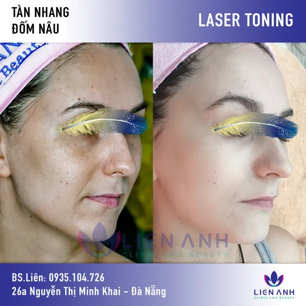 Trị nám đa công nghệ