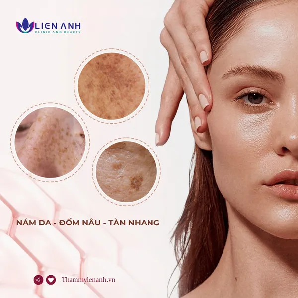 Trị tàn nhang - Laser Toning