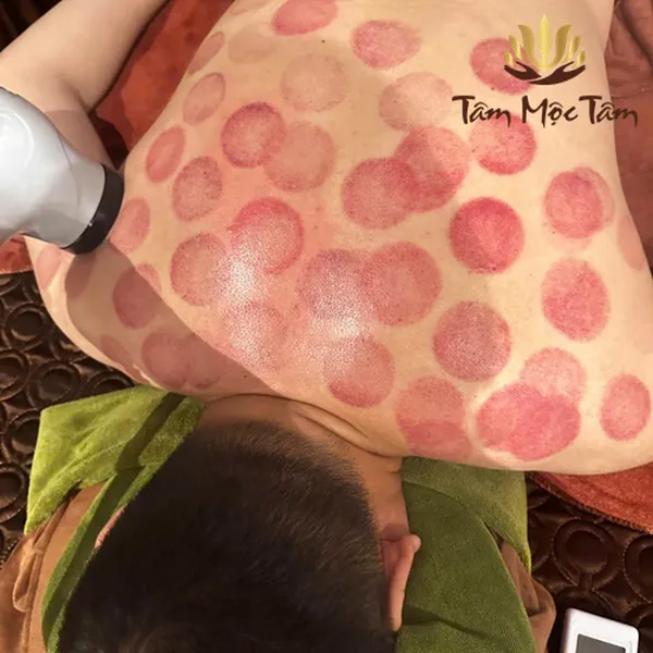 Giác hơi bằng máy trực tiếp, Bài khí Hàn