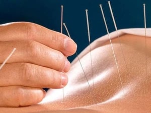 Đạo Tạo Châm Cứu tại Hải Phòng