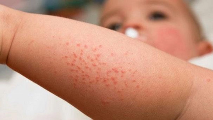 Vì sao rôm sảy dễ tái phát ở bé Vì sao rôm sảy dễ tái phát ở bé