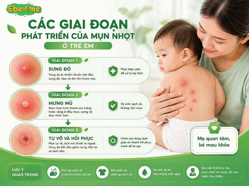Các Giai Đoạn Phát Triển Của Mụn Nhọt Ở Trẻ Em Các Giai Đoạn Phát Triển Của Mụn Nhọt Ở Trẻ Em