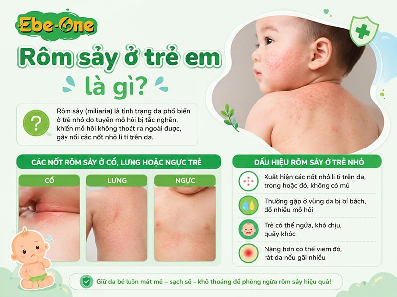 Rôm sảy ở trẻ em là gì? Rôm sảy ở trẻ em là gì