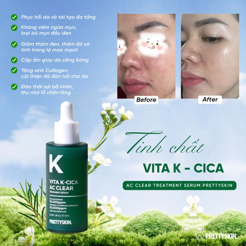 TINH CHẤT SERUM VITA K – CICA AC CLEAR TREATMENT SERUM PRETTYSKIN