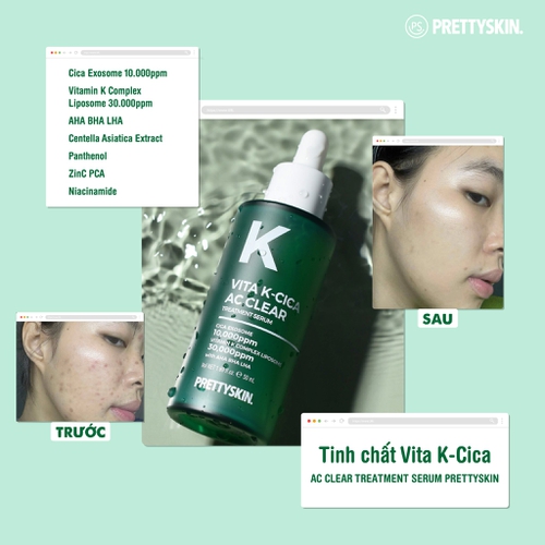 TINH CHẤT SERUM VITA K – CICA AC CLEAR TREATMENT SERUM PRETTYSKIN