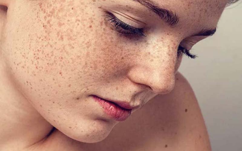 Đánh bay tình trạng sạm đen