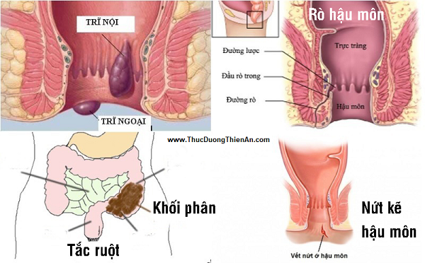 Táo bón là nguyên nhân gây ra bệnh trĩ và các bệnh đường ruột