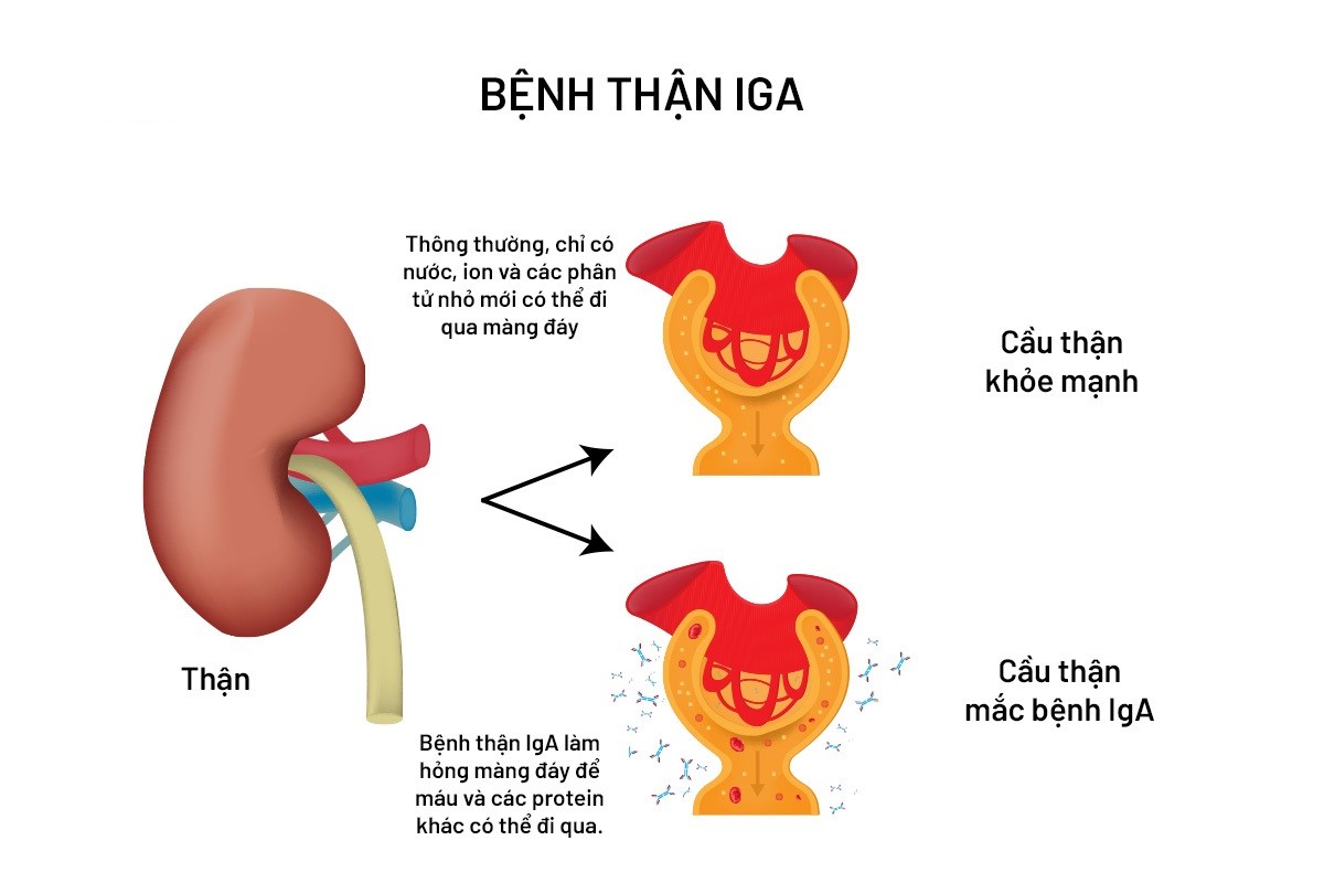 BỆNH THẬN IGA (BERGER): NGUYÊN NHÂN, TRIỆU CHỨNG VÀ PHƯƠNG PHÁP ĐIỀU TRỊ