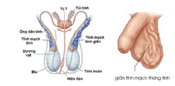 GIÃN TĨNH MẠCH THỪNG TINH CÓ LÀM ẢNH HƯỞNG ĐẾN SINH LÝ?