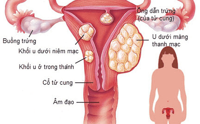 U XƠ TỬ CUNG: NGUYÊN NHÂN, DẤU HIỆU VÀ CÁCH ĐIỀU TRỊ HIỆU QUẢ