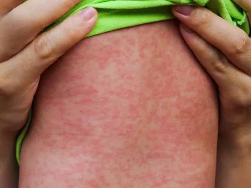 BỆNH SỞI Ở TRẺ EM: DẤU HIỆU, BIẾN CHỨNG, VÀ CÁCH PHÒNG NGỪA HIỆU QUẢ